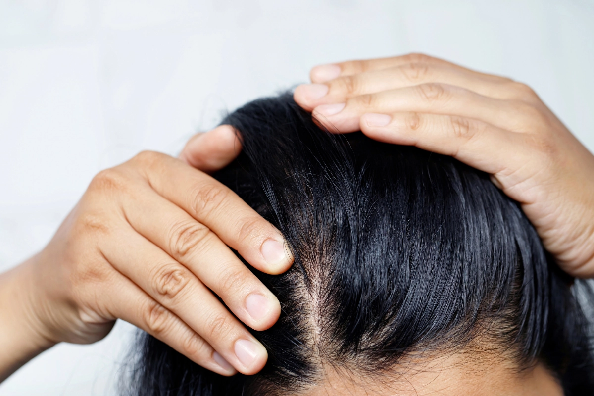 Sucha skóra głowy — przyczyny, leczenie i domowe sposoby na nawilżenie skóry głowy